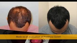 Best laser hair growth device  Laser Treatments for Thinning Hair [upl. by Nesnaj]