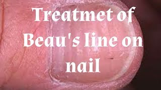 Beaus lines on toenail [upl. by Ruyle]