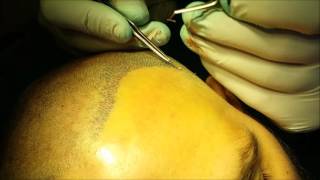 FUE Hair Transplant  Wimpole Clinic [upl. by Merwin]