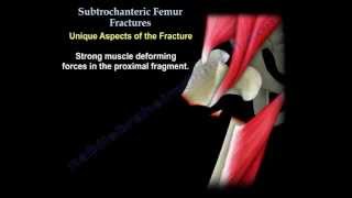 Subtrochanteric Femur Fractures  Everything You Need To Know  Dr Nabil Ebraheim [upl. by Nichole]