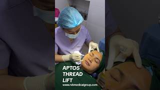 Aptos Thread Lift [upl. by Atived]