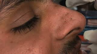 YouTube Blackheads Nose Blackheads poppingblackheads [upl. by Erie]