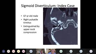 Pulsatile Tinnitus Dr Douglas Mattox Emory University [upl. by Ettennad]