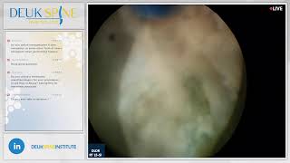 Watch Live Back Treatment Deuk Laser Disc Repair  Lumbar  RT L5S1 [upl. by Ahselyt870]