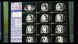 Documentação  Angiotomografia Aorta torácica [upl. by Farrington]