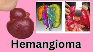 Liver Hemangioma Causes Symptoms Diagnosis amp Treatment [upl. by Freud756]