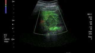 Hepatocellular Carcinoma pictured using CEUS [upl. by Muir]