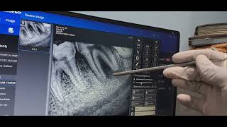 EXTRACTION AND ENUCLEATION OF BONE OF LEFT MANDIBULAR SECOND MOLAR TEETH [upl. by Anagrom402]