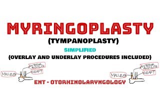 Myringoplasty Tympanoplasty  Ear surgeries  Overlay and Underlay  ENT  Otorhinolaryngology [upl. by Ingaberg991]