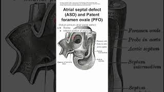 Atrial septal defect ASD and Patent foramen ovale PFO [upl. by Dulcle]