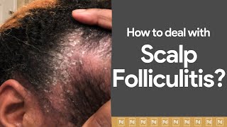 Dealing with Scalp Folliculitis Watch immediately [upl. by Yort]