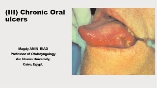 III Chronic Oral Ulcers [upl. by Eliason]