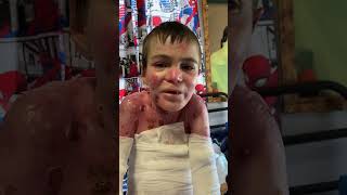 Marky was born with epidermolysis bullosa recessive dystrophic explore trending explorepage [upl. by Tali]