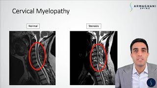 Cervical Myelopathy  What is it How can we treat it [upl. by Angeline]