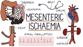 Understanding Mesenteric Ischaemia [upl. by Yrdua]