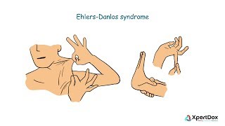 What is Ehlers Danlos Syndrome [upl. by Akselav760]