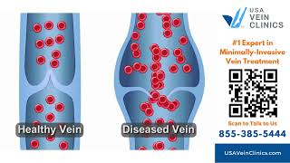 MinimallyInvasive Vein Treatment for Varicose Veins and Spider Veins at USA Vein Clinics [upl. by Gally139]