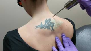 Laser Tattoo Removal  DermMedica [upl. by Broddy326]