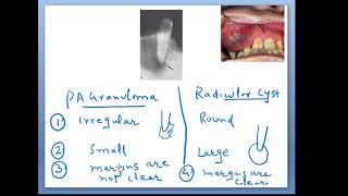 Radicular cyst Concepts Radiographic Features [upl. by Ahsuoj]