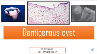 Dentigerous Cyst [upl. by Ahsiki85]