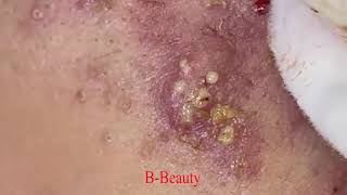 Pimple Removal and Acnes Treatment  BBeauty 07 [upl. by Mik518]