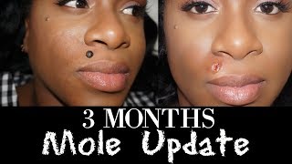 Three Months Mole Removal UpdateSo Trudee [upl. by Eiramait]