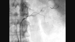 Стентирование почечных артерий [upl. by Stan]