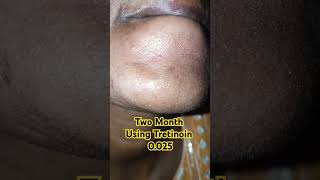 Two Month update Using Tretinoin 0025 skincare tretinoin tretinoincream shorts [upl. by Eolc]