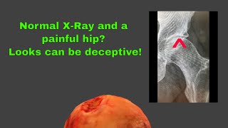 Painful hip and a normal XRay Looks can be deceptive [upl. by Politi]