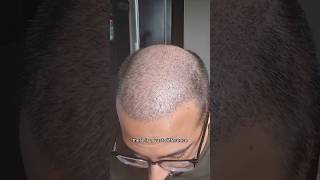 Do this 2 weeks after a hair transplant hairtransplant hairloss hairrecovery [upl. by Ornstead213]