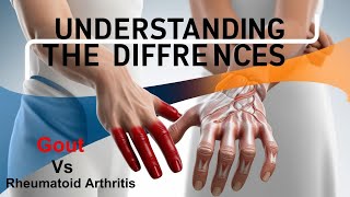 Gout Vs Rheumatoid Arthritis Understanding the Differences [upl. by Oilime]