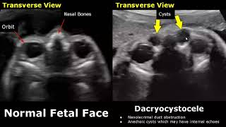 Fetal Face Ultrasound Normal Vs Abnormal Image Appearances  Eye Abnormalities  Obstetric USG [upl. by Noneek]