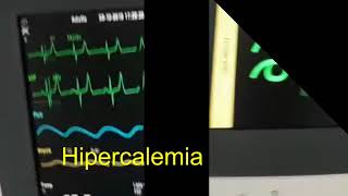 Hipercalemia Hiperpotassemia pré e pós Gluconato de Cálcio [upl. by Ashraf]