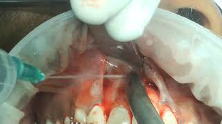 part 2 inverted and impacted  internal resobed mesiodens surgical removal [upl. by Barvick226]