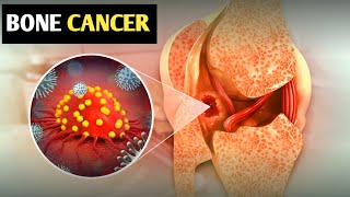 Bone Cancer Everything You Need To Know about Early Detection and Treatment [upl. by Notsae]