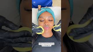 Watch how we can FIX hyperpigmentation in Dark Skin [upl. by Antoinetta]