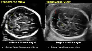 Edwards Syndrome Trisomy 18 Antenatal Ultrasound Features  Fetal USG Normal Vs Abnormal Images [upl. by Andras]