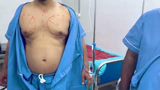 Gynecomastia Surgery Marking in Bangladesh by Dr Sharif [upl. by Eetnwahs]