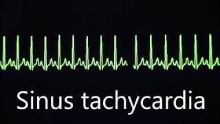 Cardiovascular System 8 Normal and abnormal heart rhythms [upl. by Josephina238]