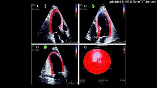 Left ventricular global longitudinal strain GLS analysis using twodimensional 2D speckletracki [upl. by Leirol436]