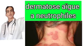 dermatose aïgue fébrile a neutrophiles [upl. by Nadab]