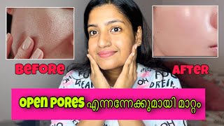 Open pores എന്നേന്നേക്കുമായി മാറ്റാൻ ഒരു skin care skincare tips malayalam care [upl. by Thurnau961]