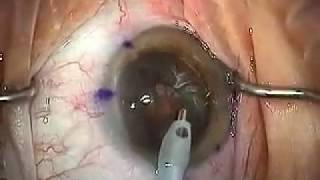 Modern Cataract Surgery Alcon ReSTOR IOL with LRI [upl. by Ahsimed]