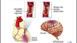 What is Heart Disease Its risk Symptoms and Conventional Treatments [upl. by Nednyl]