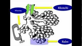 Abnormal Lung Sounds [upl. by Algie]