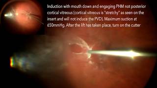 PVD induction from temporal macula [upl. by Asaret]