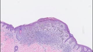 Study examines accuracy of melanoma biopsy findings [upl. by Ahsei]