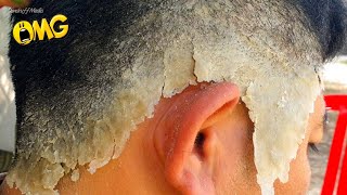 Itchy Psoriasis Scalp Removal At Home 191 [upl. by Zailer]