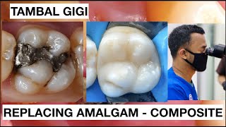 Step by Step Replacing Amalgam to Resin Composite  General Dentist Griya RR [upl. by Stevena]