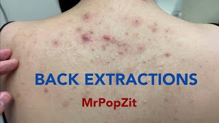 Tons of blackheads on the back Acne extractions Blackheads and whiteheads Mining pore dirt [upl. by Emoreg]